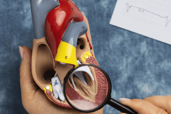 Percutaneous Valvuloplasty Mitral, Pulmonary, Aortic (BMV, BPV, BAV)