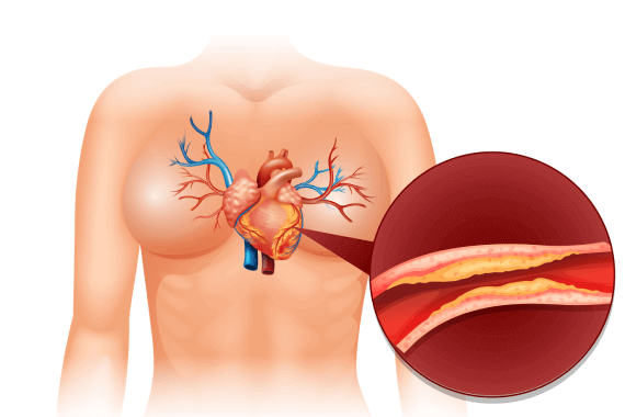 Rotational Atherectomy and Thrombosuction